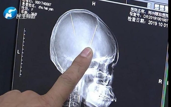 Sau tai nạn ô tô người phụ nữ Trung Quốc bất ngờ phát hiện có hai cây kim được găm vào trong não mà không hề có ký ức gì