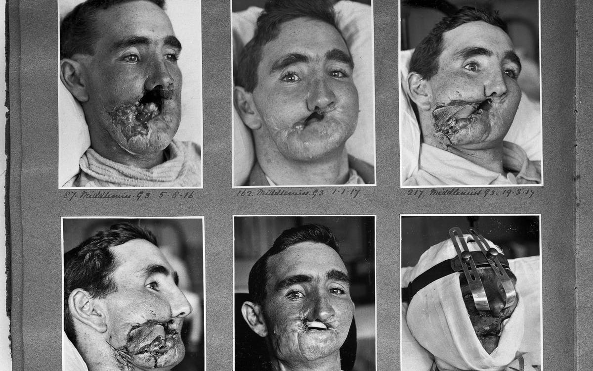 Câu chuyện bi thảm về hàng trăm phi công &quot;chuột lang&quot; trong thế chiến II và vị bác sĩ đã giúp họ tìm lại hình hài con người