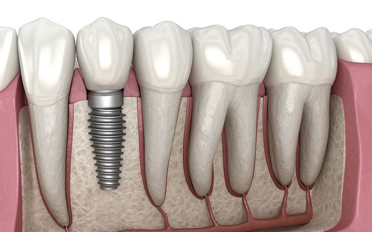 Bước tiến lớn trong công nghệ cấy ghép implant tại Việt Nam