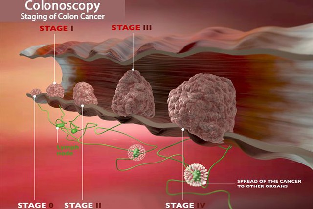 Có thật các bác sĩ Mỹ đã chữa khỏi được 100% ung thư đại trực tràng? - Ảnh 7.