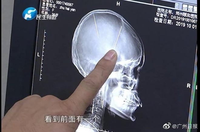Sau tai nạn ô tô người phụ nữ Trung Quốc bất ngờ phát hiện có hai cây kim được găm vào trong não mà không hề có ký ức gì - Ảnh 1.