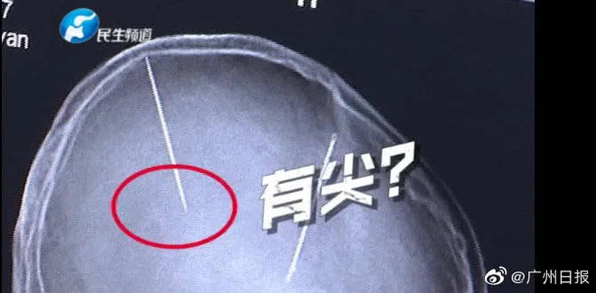 Sau tai nạn ô tô người phụ nữ Trung Quốc bất ngờ phát hiện có hai cây kim được găm vào trong não mà không hề có ký ức gì - Ảnh 3.
